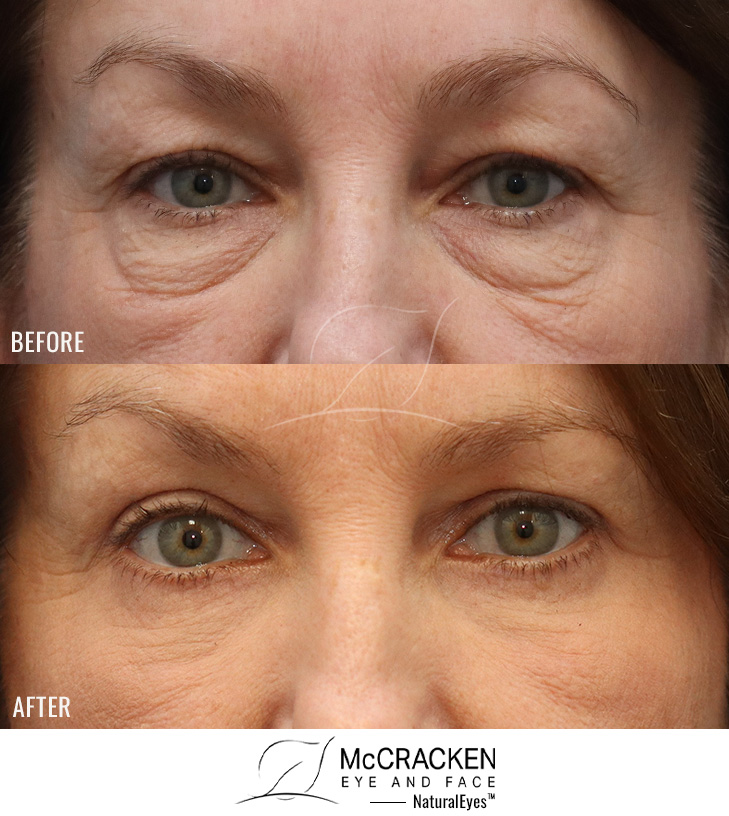 61 Year Old Female – Upper Lid Blepharoplasty, Lower Lid Blepharoplasty with Fat Repositioning and skin pinch excision, and AccuTite Radiofrequency Tightening to Malar Mounds(cheek swelling below the lower lids).