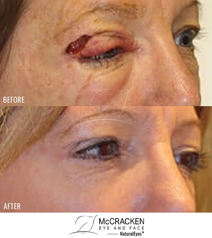 50 Year old female – Repair of right upper lid defect after skin cancer excision