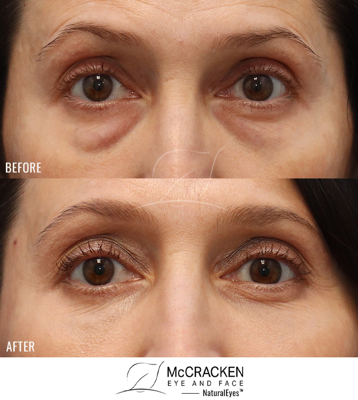 50 Year Old Female – Lower Lid Blepharoplasty with Fat Repositioning, Injection of 3cc of Fat to Each Cheek, and injection of 1cc of nanofat to each lower lid. Lower Lid Skin Pinch Excisions were performed. Postop photos are 6 weeks after surgery.