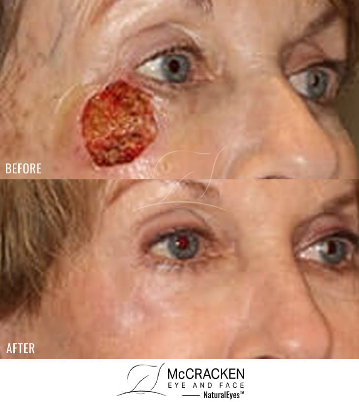 75 year old female – Repair of right cheek defect after skin cancer excision