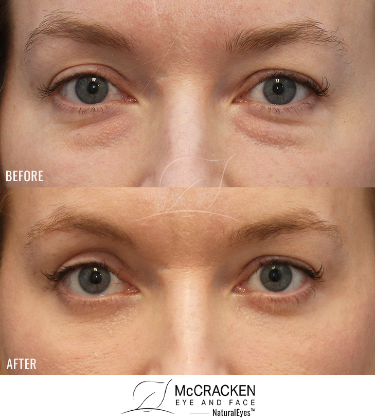 34 Year Old Female – Lower Lid Blepharoplasty with Fat Repositioning and Laser Skin Resurfacing. No Lower Lid Skin Incisions were made.