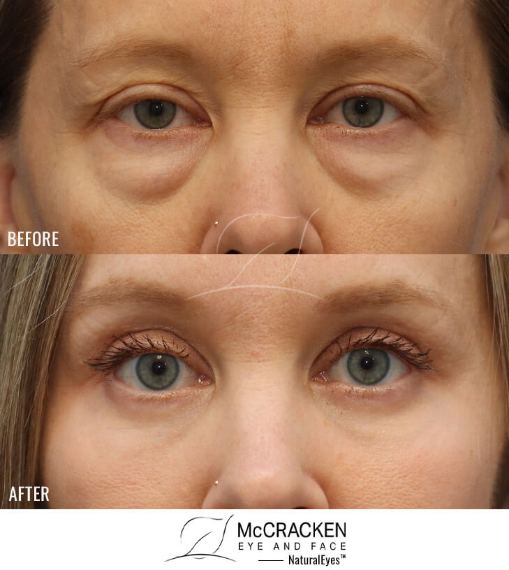 44 Year Old Female Upper and Lower Lid Blepharoplasty with Injection of 4cc of Fat to Each Cheek, and Laser Skin Resurfacing.