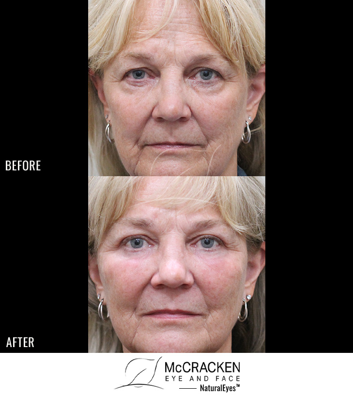 68 Year Old Female – Mid-Facelift with Lower Blepharoplasty, Periocular Laser Skin Resurfacing, and Temporal Brow Lift. The Mid-Facelift was performed through incisions in the mouth and temples, without any skin incisions.