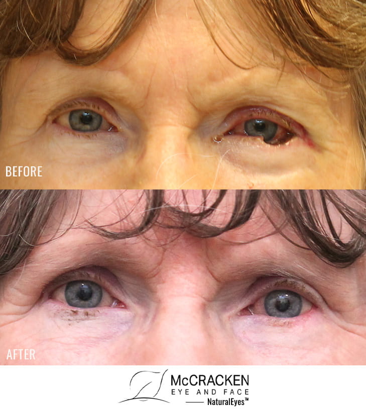 65 year old female – Repair of left lower lid Mohs defect after excision of basal cell carcinoma