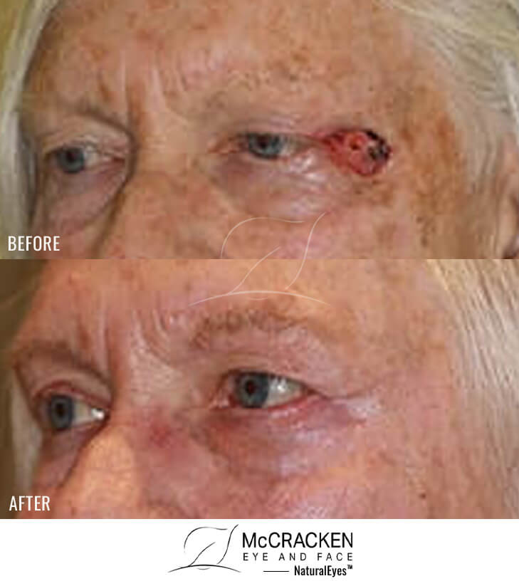 72 year old female -Repair of left lateral canthal defect after skin cancer excision