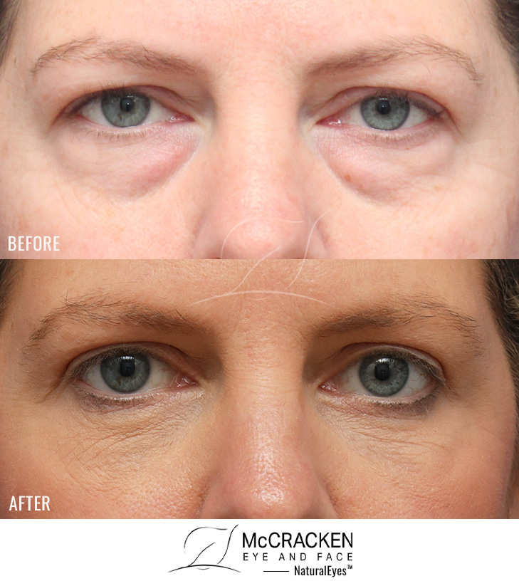 42 Year Old Female – Upper and Lower Blepharoplasty with Periocular Laser Skin Resurfacing. No lower lid skin incisions were made.