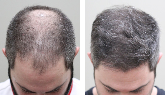  Before and After Picture 
31 year old male, 7 months after 3000 grafts to the hairline and crown.