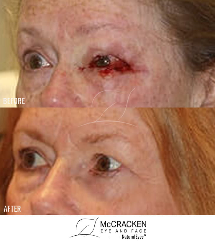 65 year old female – Repair of left upper and lower lid defect after skin cancer excision