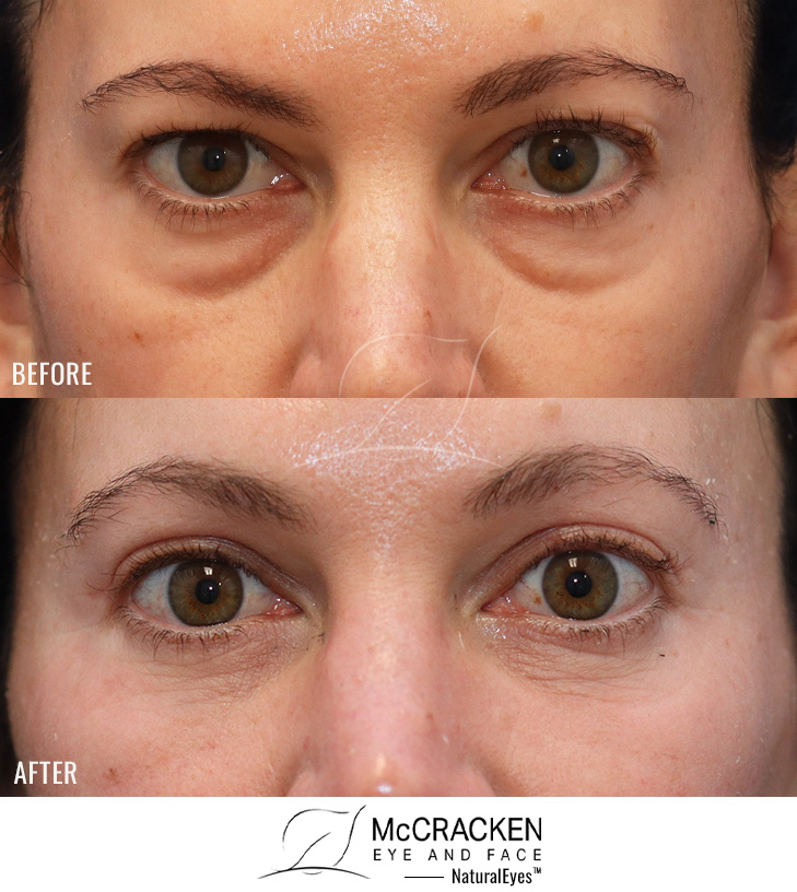 40 Year Old Female – Temporal Brow Lift, Upper and Lower Lid Blepharoplasty with Fat Repositioning, Injection of 4cc of Fat to Each Cheek, Injection f 1cc of Fat to Each Temple, and Nanofat Injection to the Lower Eyelids.