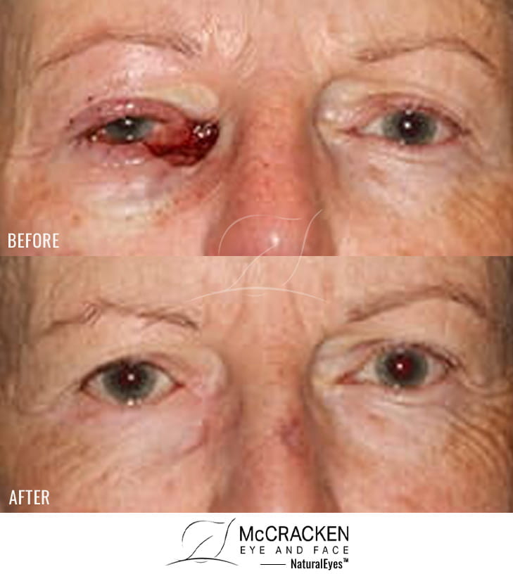 61 year old female – Repair of left lower lid and medial canthal defect after skin cancer excision