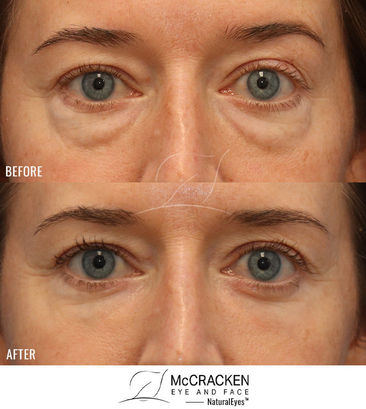 38 Year Old Female – Lower Lid Blepharoplasty with Fat Repositioning and Laser Skin Resurfacing. No Lower Lid Skin Incisions were made.