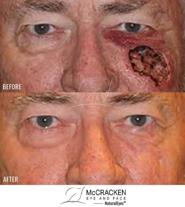 74 year old male – Repair of left cheek defect after skin cancer excision