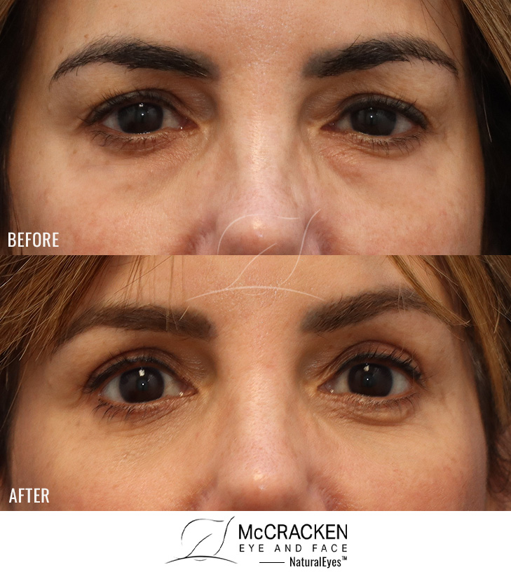 54 Year Old Female – Lower Lid Blepharoplasty with Fat Repositioning, Injection of 4cc of Fat to Each Cheek. No Lower Lid Skin Incisions were made.