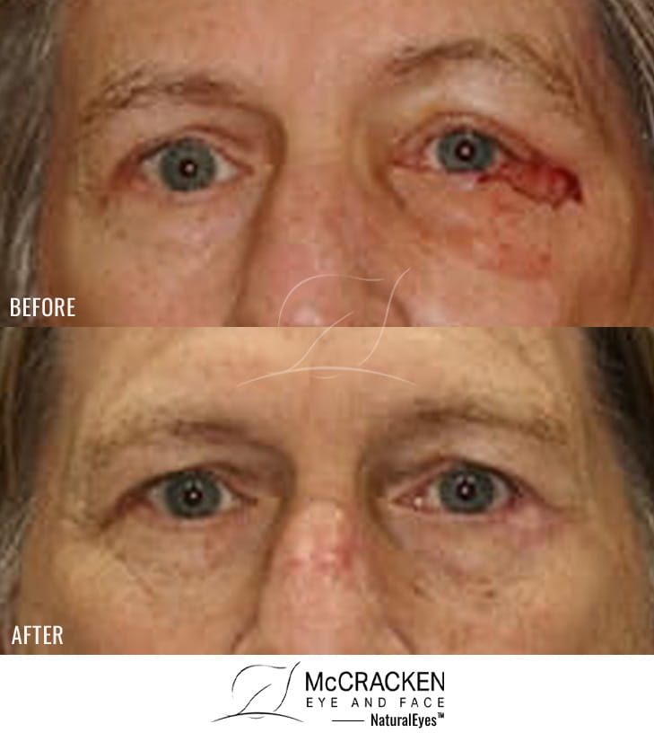 59 year old male – Repair of left lower lid and lateral canthal defect after skin cancer excision