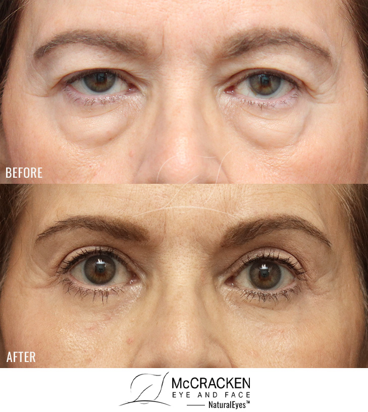 70 Year Old Female – Upper and Lower Lid Blepharoplasty with Right Upper Lid Ptosis Repair, Injection of 5cc of Fat to Each Cheek, and Laser Skin Resurfacing. No Lower Lid Skin Incisions were made.