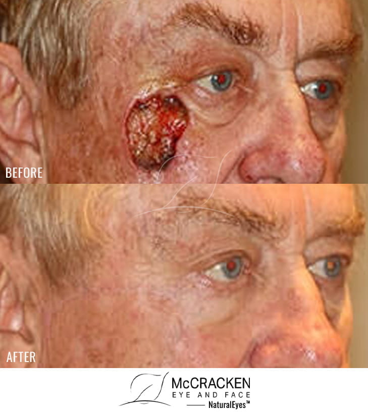 80 year old male – Repair of right cheek defect defect after skin cancer excision