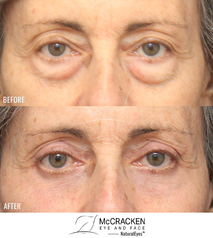 67 Year Old Female – Upper and Lower Lid Blepharoplasty with Injection of 2.5cc of Fat to Each Cheek and Laser Skin Resurfacing. No Lower Lid Skin Incisions were made.