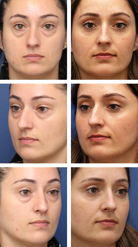  Before and After Picture 
36 Year Old Female – Lower Lid Blepharoplasty with Fat Repositining, Injection of 4cc of Fat to Each Cheek and Laser Skin Resurfacing. No Lower Lid Skin Incisions were made.