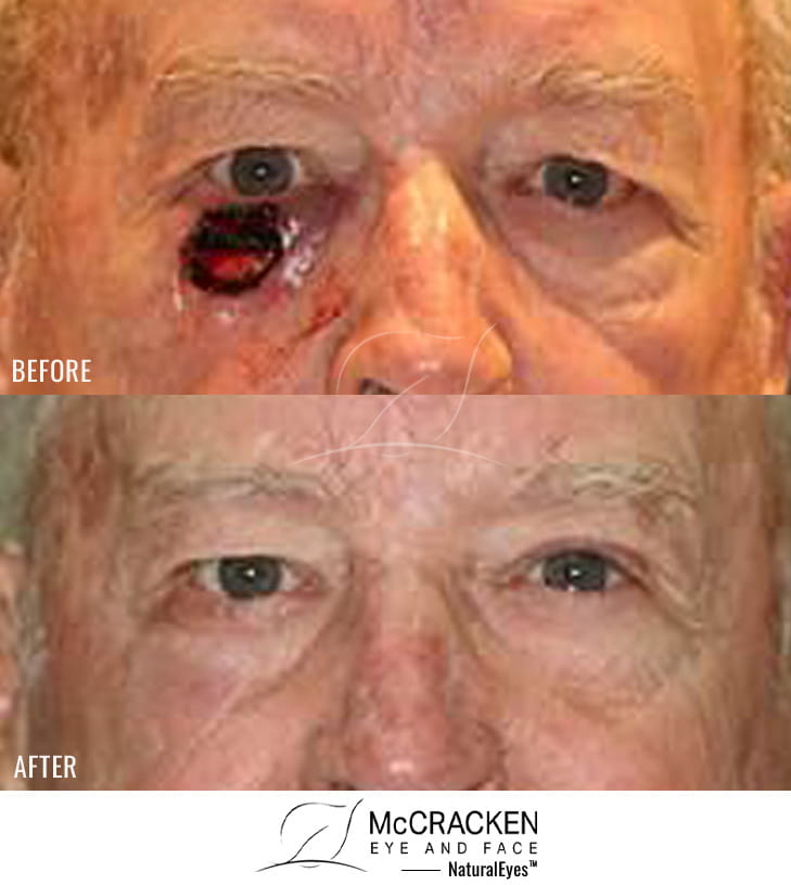 86 year old male – Repair of right lower lid defect after skin cancer excision