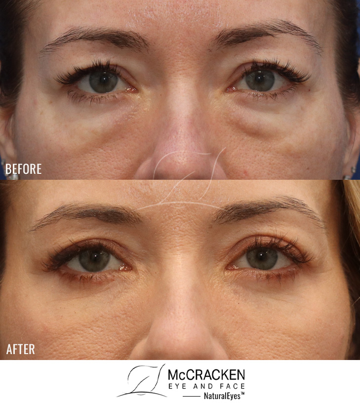 46 Year Old Female – Temporal Brow Lift, Upper and Lower Lid Blepharoplasty with Fat Repositioning, Injection of 3cc of Fat to Each Cheek, and Laser Skin Resurfacing.