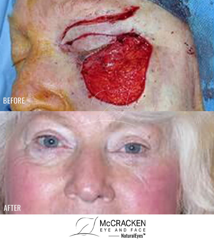 71 year old female – Repair of left lower lid defect after skin cancer excision