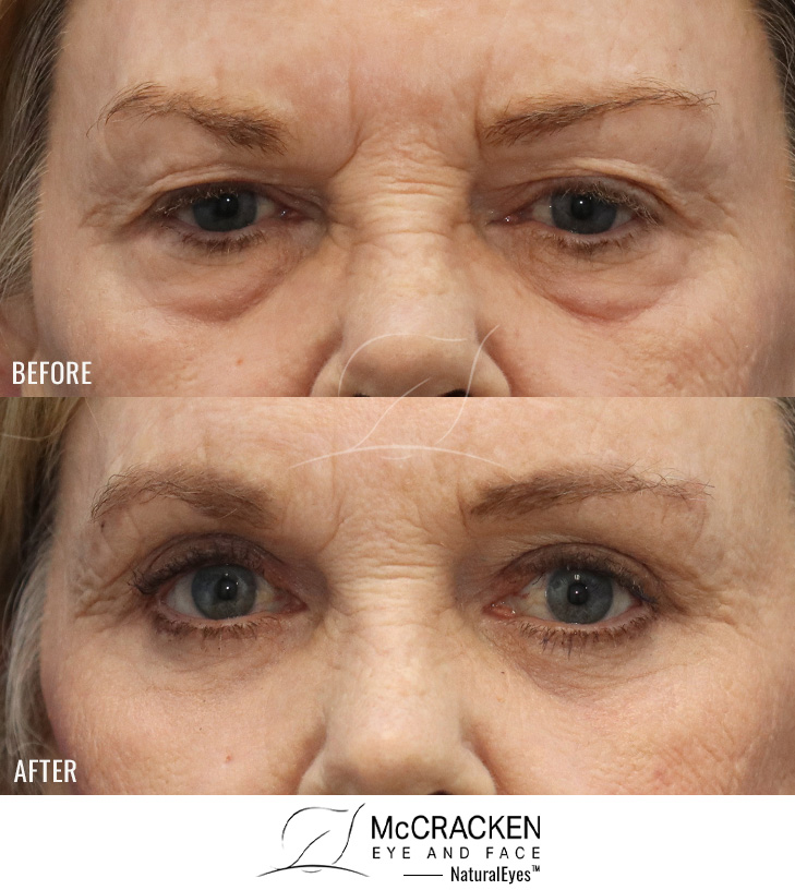 54 Year Old Female – Endoscopic Brow Lift with Upper Lid Blepharoplasty, Lower Lid Blepharoplasty with Fat Excision, Fat Transfer to the Cheeks (5.5 cc on the Right and 3.5 cc on the Left), and Periocular Laser Skin Resurfacing. The brow lift was fixated with EndoTines. No Lower Lid Skin Incisions Were Made.
