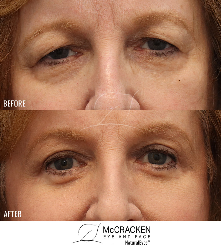 74 Year Old Female – Upper and Lower Blepharoplasty (Skin Muscle Flap Excision for Lower Lids)