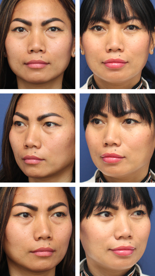  Before and After Picture 
39 Year Old Female – Lower Blepharoplasty With Fat Repositioning. No skin incisions were made.