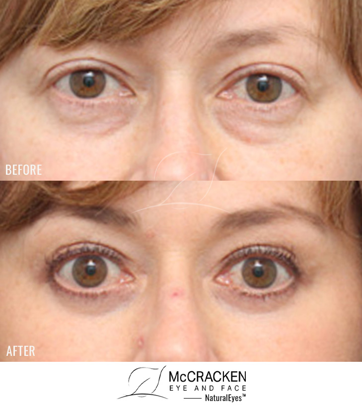 56 Year Old Female – Lower Blepharoplasty with Periocular Laser Skin Resurfacing. No lower lid skin incisions were made.
