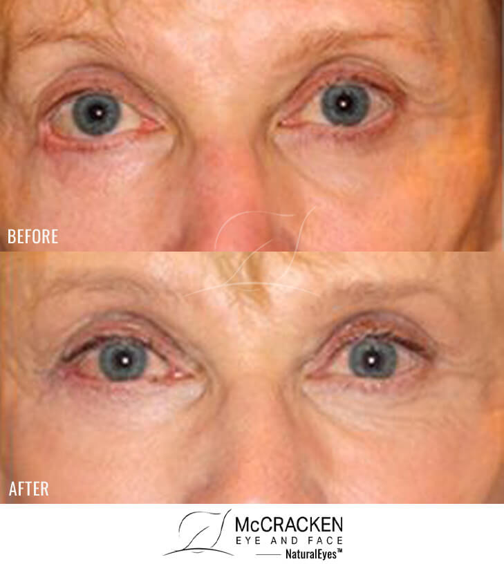 67 Year Old Female – Repair of Lower Lid Retraction