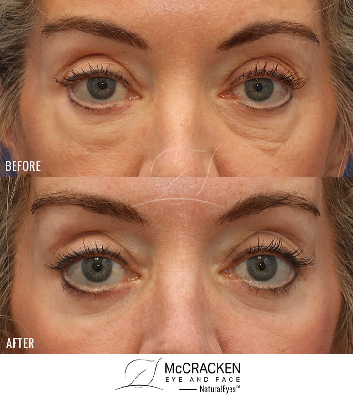 60 Year Old Female Lower Lid Blepharoplasty with Fat Repositioning, Injection of 5cc fat per cheek, and laser skin resurfacing. No lower lid skin incisions were made.