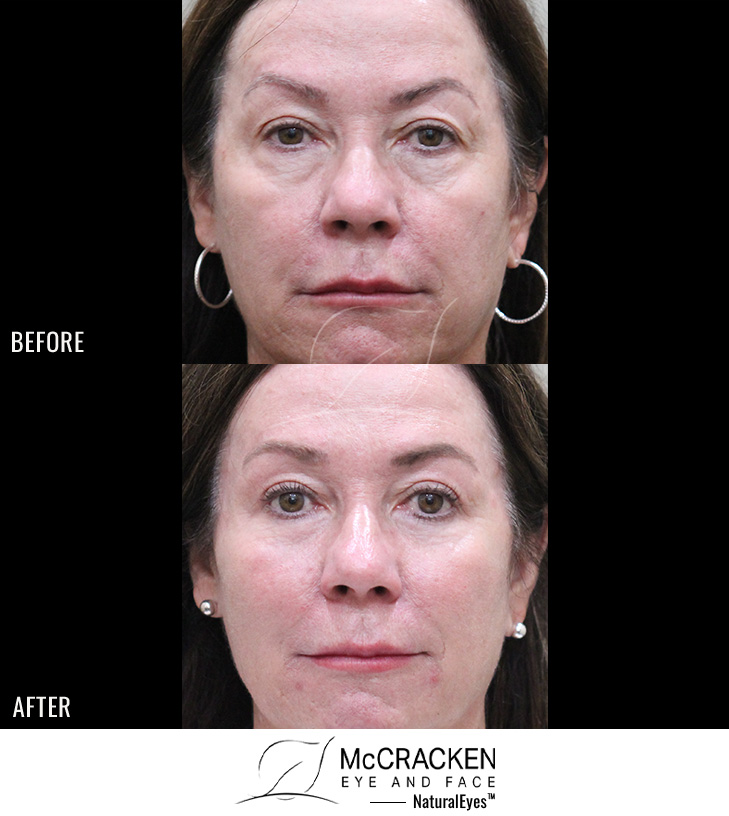 60 Year Old Female – Mid-Facelift with upper and lower blepharoplasty, and Periocular Laser Skin Resufacing. The Mid-Facelift was performed through incisions in the mouth and temples, without any skin incisions.