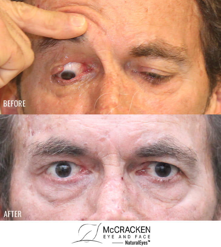 56 year old male – repair of right upper lid defect after Mohs excision of basal cell carcinoma.