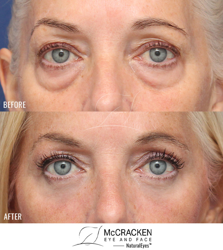 53 Year Old Female – Upper and Lower Blepharoplasty with Periocular Laser Skin Resurfacing. No lower lid skin incisions were made.