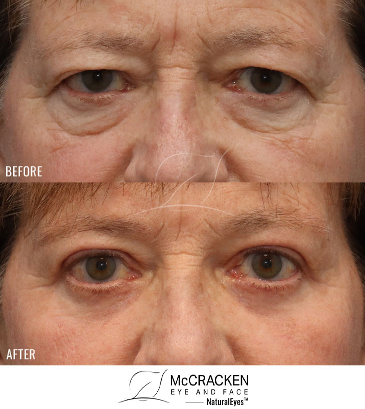 67 Year Old Female – Temporal Brow Lift, Upper and Lower Lid Blepharoplasty with Fat Repositioning, Injection of 3cc of Fat to Each Cheek, and Laser Skin Resurfacing. No Lower Lid Skin Incisions were made.