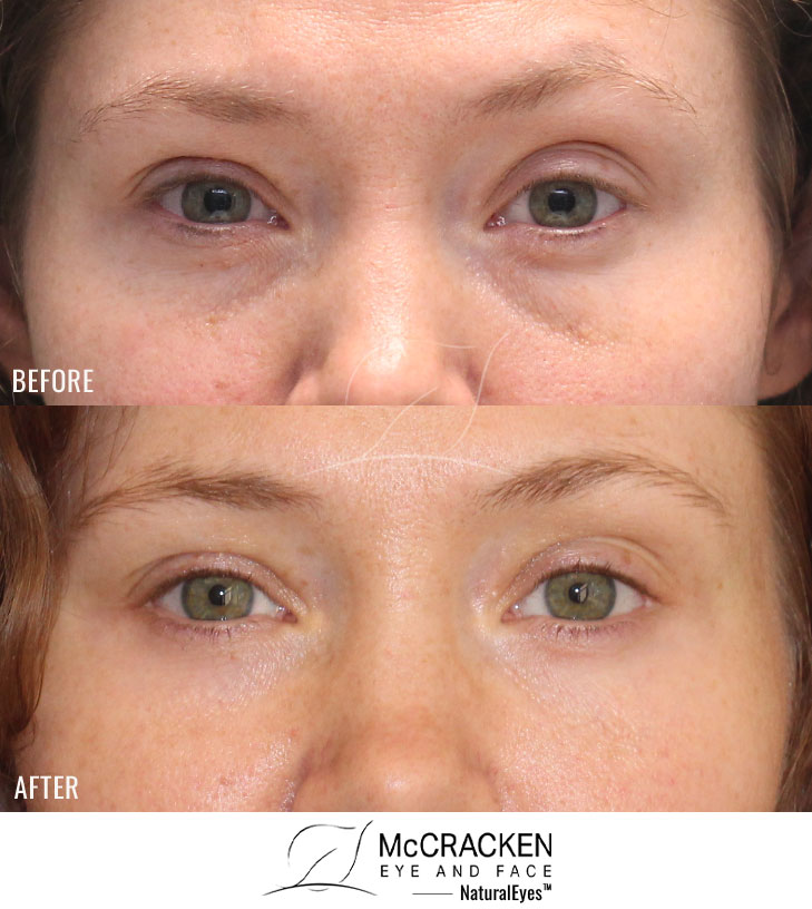 33 Year Old Female – Lower Blepharoplasty. No Skin Incisions.