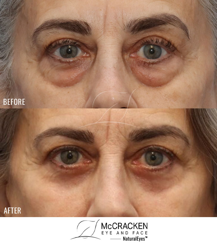 63 Year Old Female – Bilateral Lower Lid Blepharoplasty Injection of 3.5cc of Fat to Each Cheek, and Laser Skin Resurfacing. No Lower Lid Skin Incisions were made.