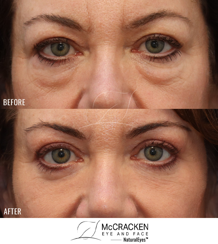 50 Year Old Female – Upper and Lower Lid Blepharoplasty with skin pinch excision with Injection of 5cc of Fat to Each Cheek and Laser Skin Resurfacing.