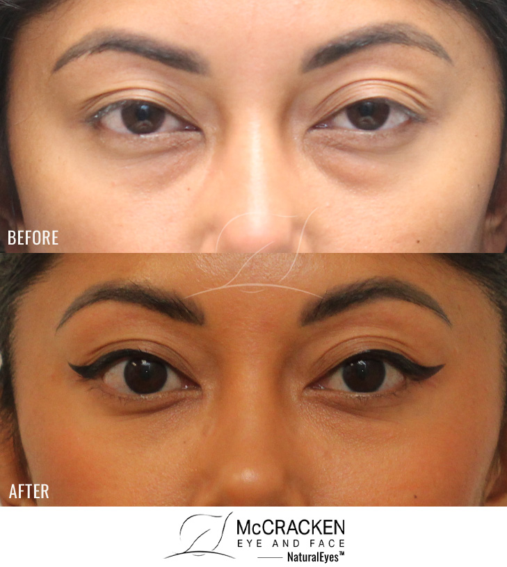 33 Year Old Female – Lower Blepharoplasty with Left Upper Lid Ptosis Repair. No Skin Incisions.