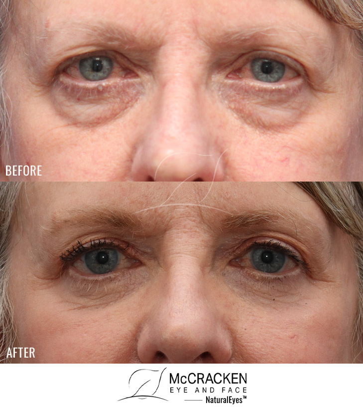 68 Year Old Female – Lower Lid Blepharoplasty with Fat Repositioning, Injection of 4cc of Fat to Each Cheek, and Laser Skin Resurfacing. No Lower Lid Skin Incisions were made.