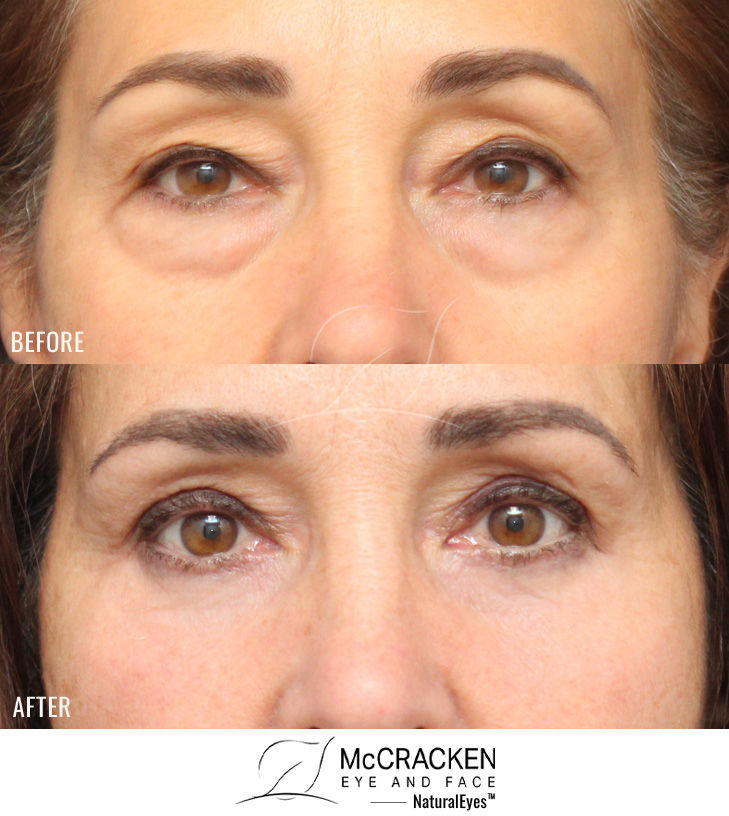56 Year Old Female – Upper and Lower Blepharoplasty with Periocular Laser Skin Resurfacing. No lower lid skin incisions were made.