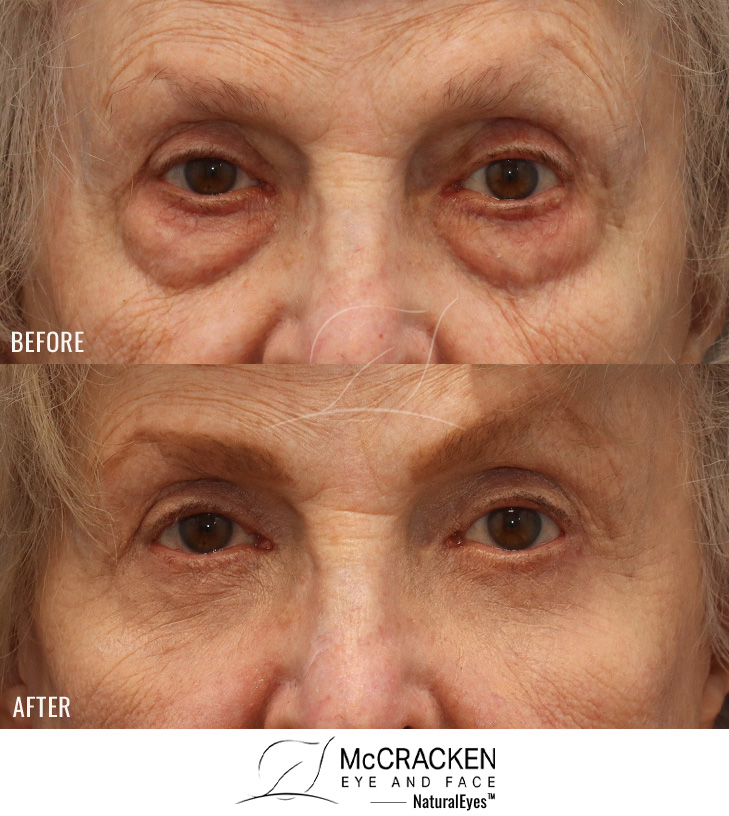 74 Year Old Female – Upper Blepharoplasty (Excision of Right upper lid skin and Trimming of Both Upper Lid Fat Pads) and Lower Blepharoplasty (Skin Muscle Flap Excision for Lower Lids)