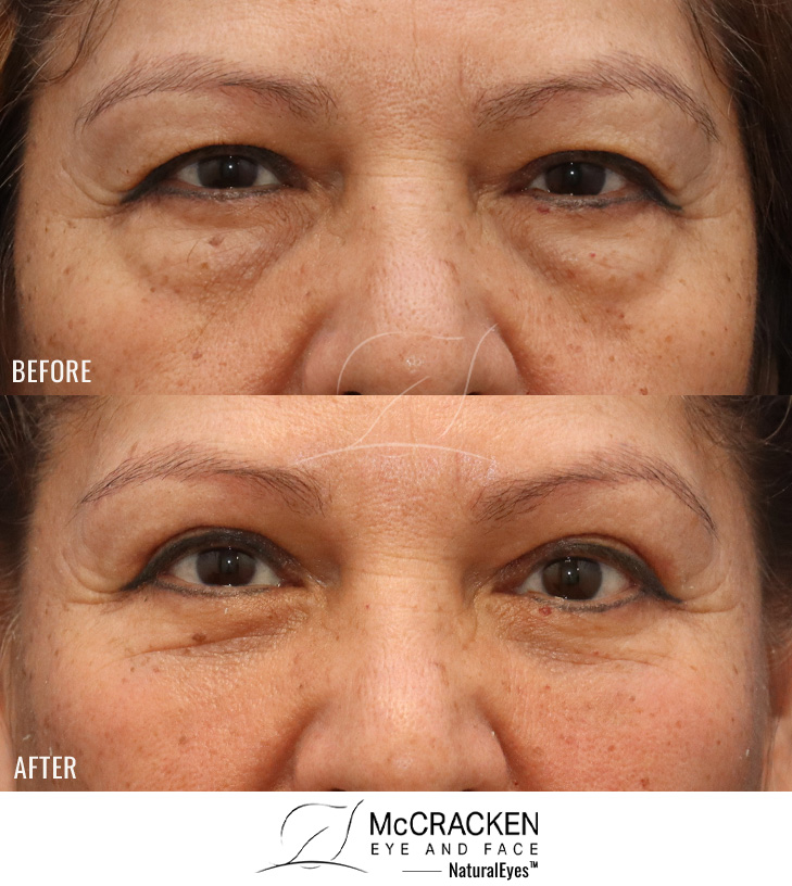 59 Year Old Female – Bilateral Upper and Lower Lid Blepharoplasty, Injection of 3cc of Fat to Each Cheek. No Lower Lid Skin Incisions were made.