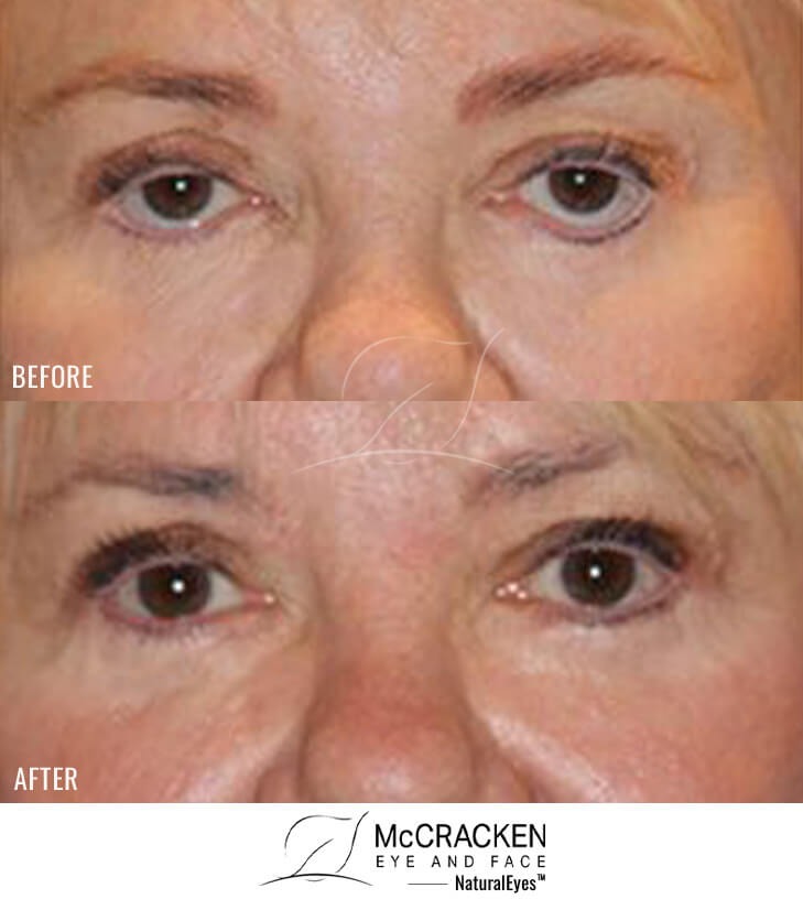 70 Year Old Female – Repair of Lower Lid Retraction After Unsatisfactory Blepharoplasty