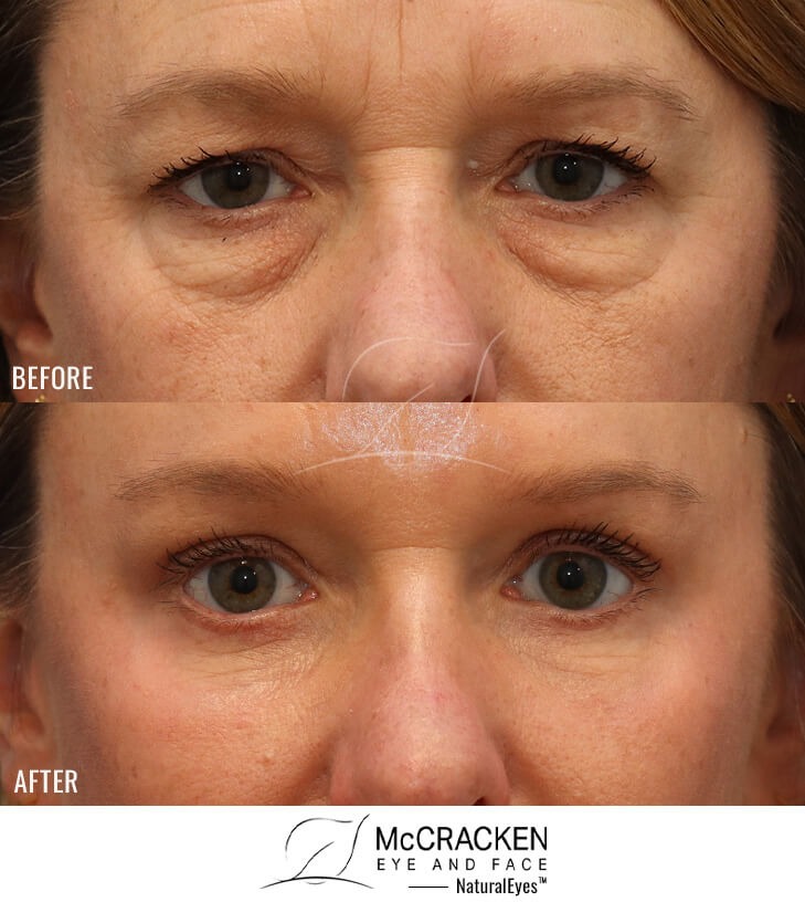 45 Year Old Female Temporal Brow Lift, Upper and Lower Lid Blepharoplasty with Fat Repositioning and lower lid skin pinch excision, Injection of 4cc of Fat to Each Cheek, and Laser Skin Resurfacing.