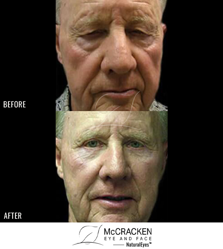 72 Year Old Male – Upper and Lower Blepharoplasty with Mid-Facelift