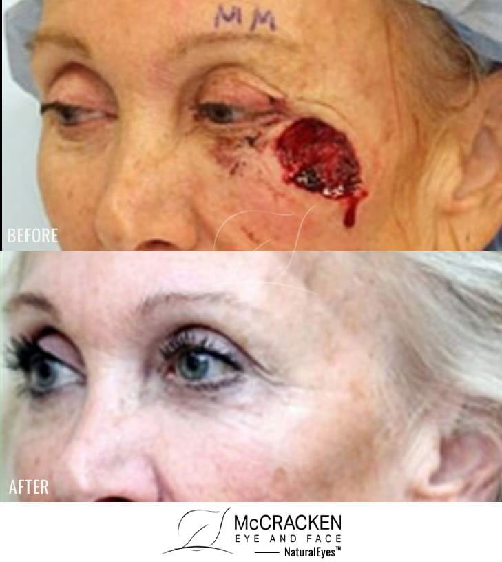 62 year old female – repair of left lower lid and cheek defect after excision of melanoma in situ.