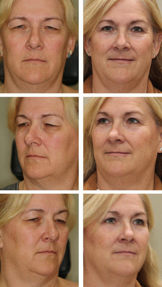  Before and After Picture  
50 year old female.  Upper and lower blepharoplasty, Left upper lid ptosis repair, Periocular laser skin resurfacing