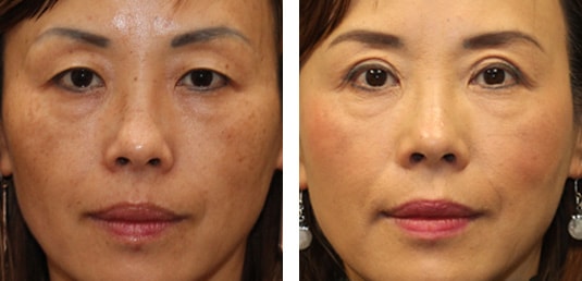  Before and After Picture  
50 year old female.  Bilateral upper blepharoplasty