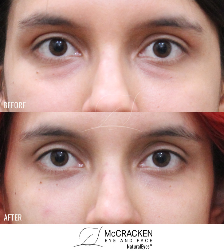 29 Year Old Female – Lower Blepharoplasty. No Skin Incisions.